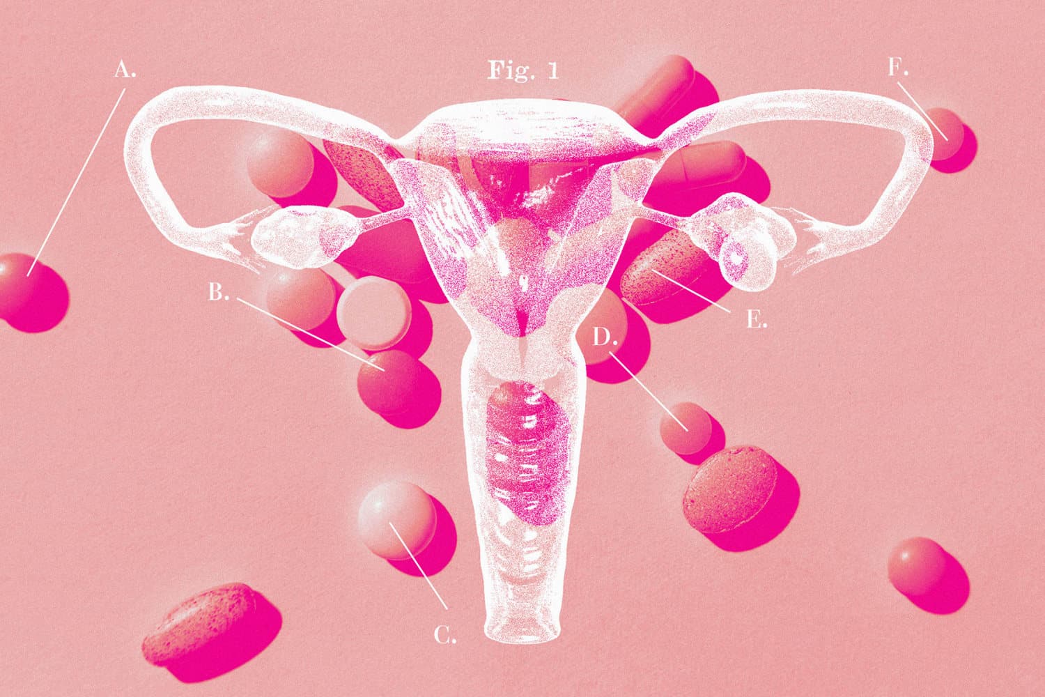 Illustration of a uterus and ovaries surrounded by scattered pills on a pink background, representing PCOS renamed PMOS — Health Pointe Jacksonville